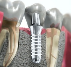 dental implant 2